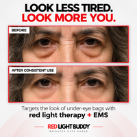 Under-eye area before and after consistent use of the Eye Snatcher Buddy