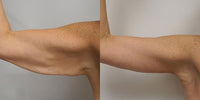 Bye-Bye Saggy Arms red light therapy bands for firming the upper arms