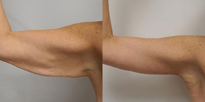 BYE-BYE SAGGY ARMS BUDDY™  CHALLENGE