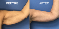 Bye-Bye Saggy Arms red light therapy bands for firming the upper arms