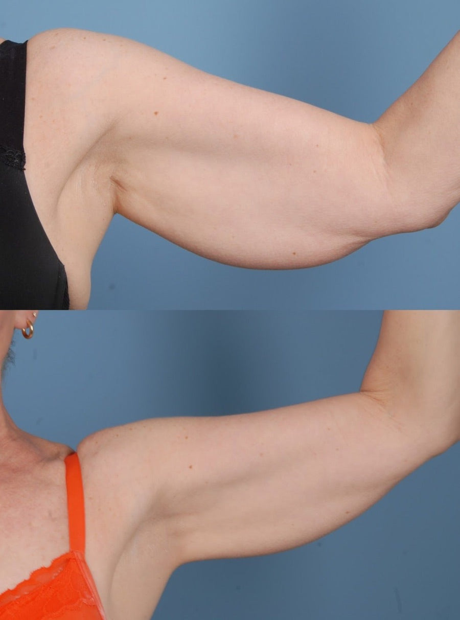 Before and after: loose underarm skin visibly firmer after using the Bye-Bye Saggy Arms bands
