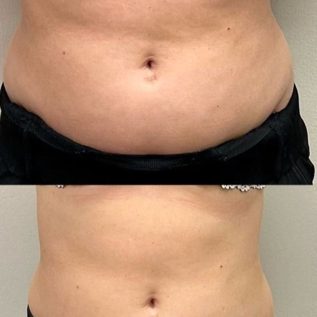 Before and after using the Slimming Massage Ring